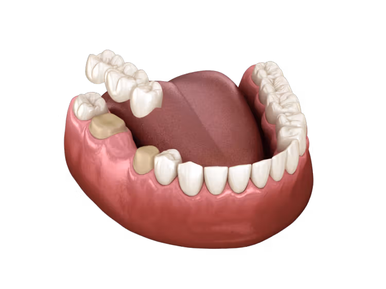 Twin Oak Dental Studio | Bridges