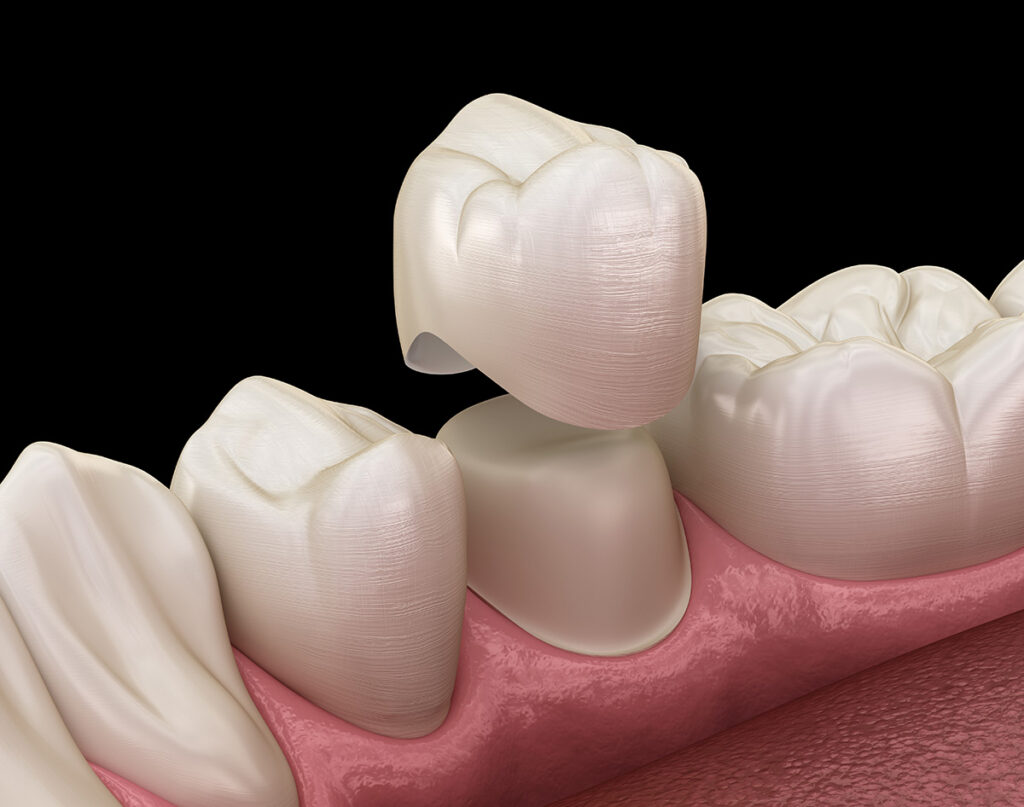 Twin Oak Dental Studio | Crowns