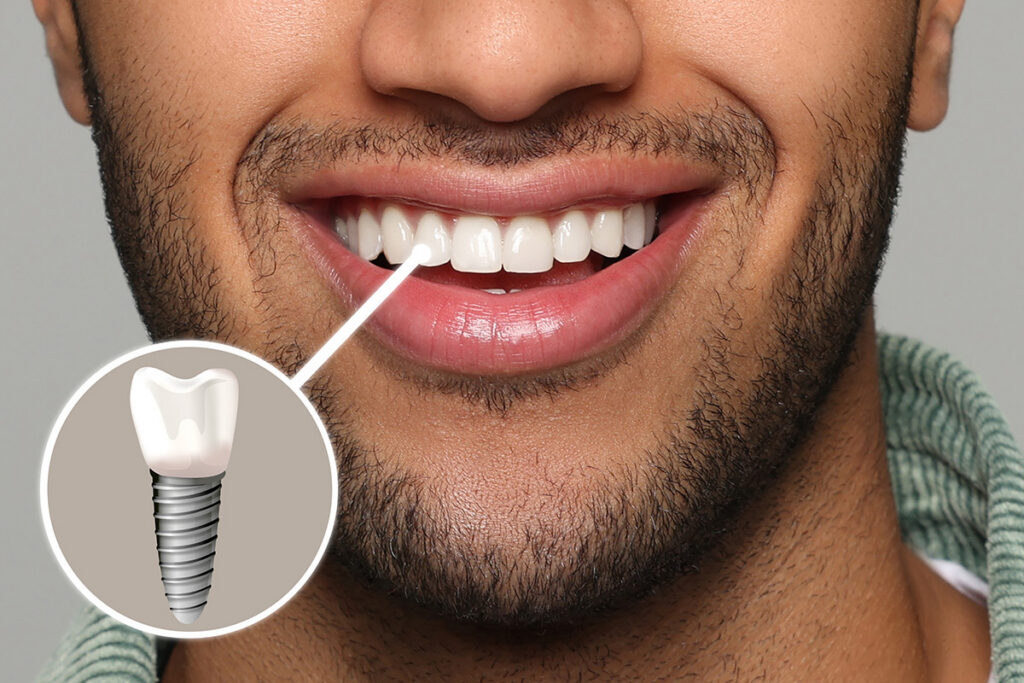 Twin Oak Dental Studio | Dental Implants