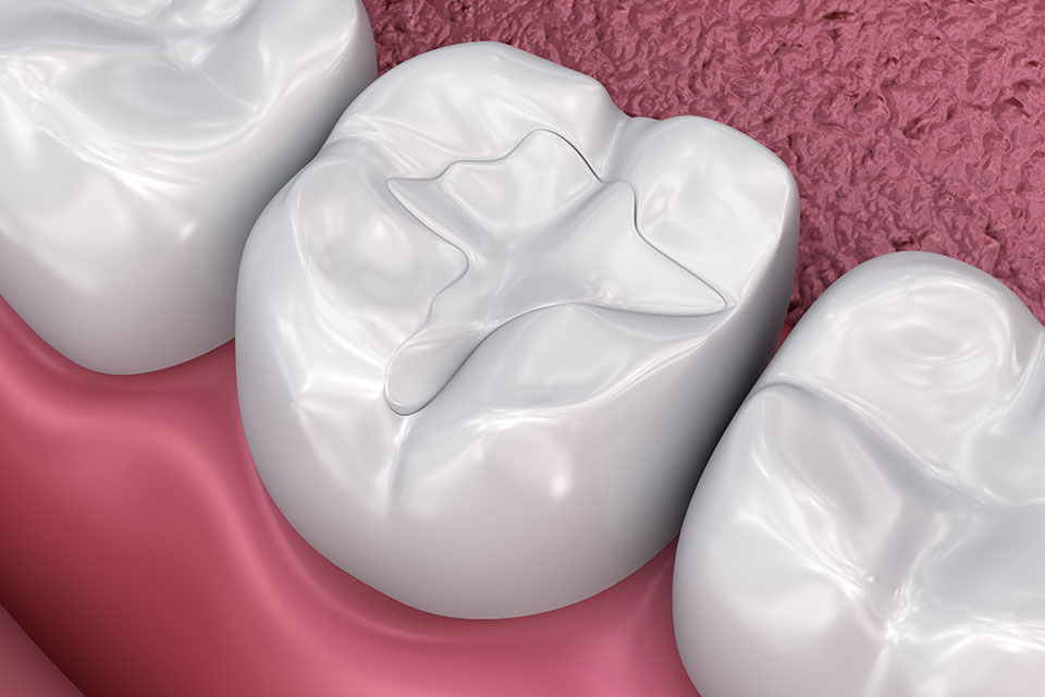 Twin Oak Dental Studio | Tooth-Colored Fillings