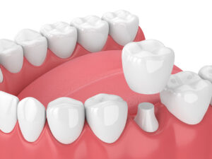 Twin Oak Dental Studio | Can You Get a Dental Crown in One Visit? A Guide to CEREC Same-Day Crowns Can You Get a Dental Crown in One Visit? A Guide to CEREC Same-Day Crowns