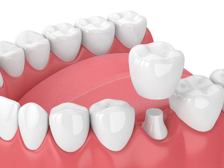Can You Get a Dental Crown in One Visit? A Guide to CEREC Same-Day Crowns