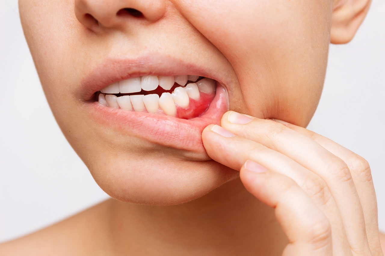 Why Do My Gums Bleed When I Brush? A West Bloomfield Guide to Gum Disease