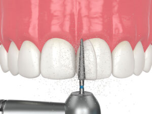 Twin Oak Dental Studio | Can Dental Bonding Fix Chipped Teeth and Small Gaps? Can Dental Bonding Fix Chipped Teeth and Small Gaps?
