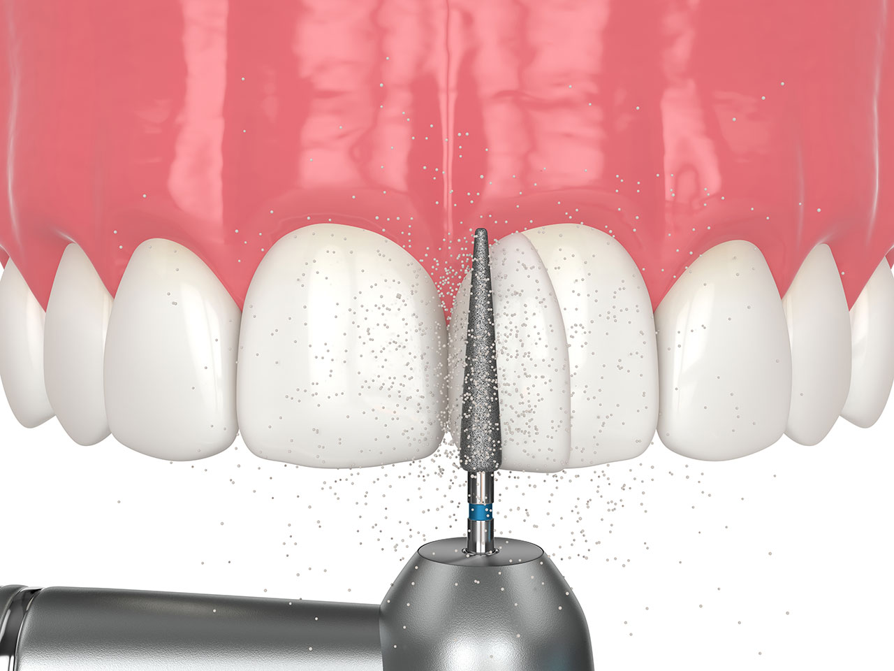 Can Dental Bonding Fix Chipped Teeth and Small Gaps?