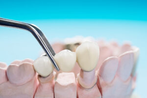 Twin Oak Dental Studio | Dental Bridge or Dental Implant: What Should You Know About Replacing a Missing Tooth? Dental Bridge or Dental Implant: What Should You Know About Replacing a Missing Tooth?